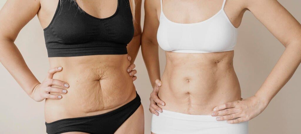 8 what does tummy tuck cosmetic surgery consist of