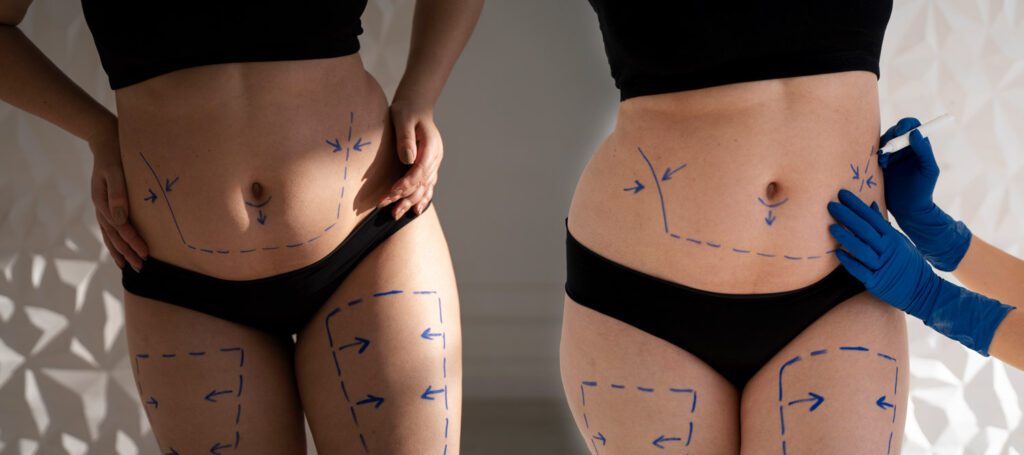 What is Liposuction