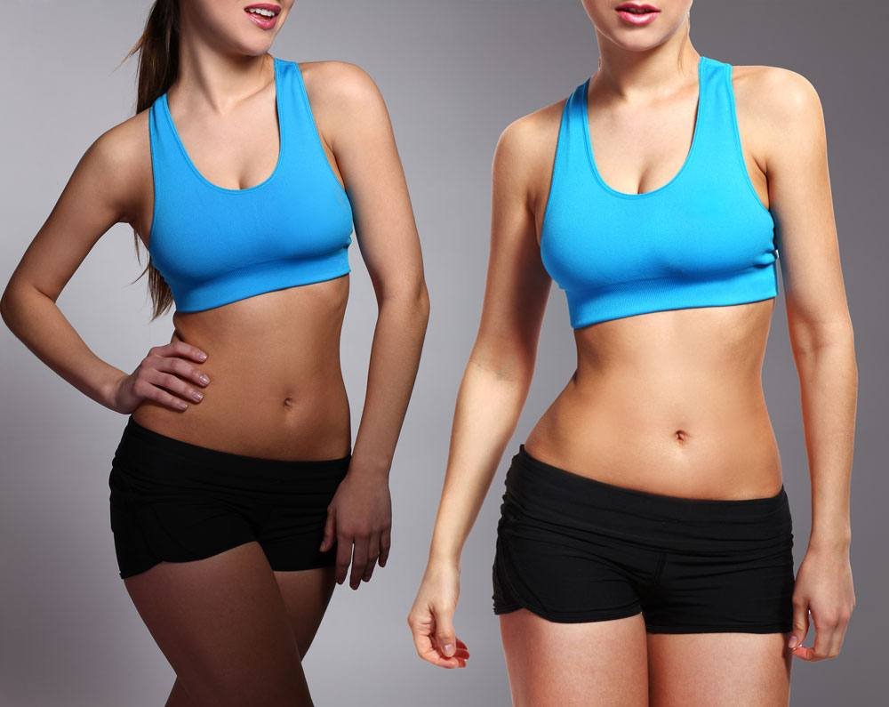Tummy Tuck