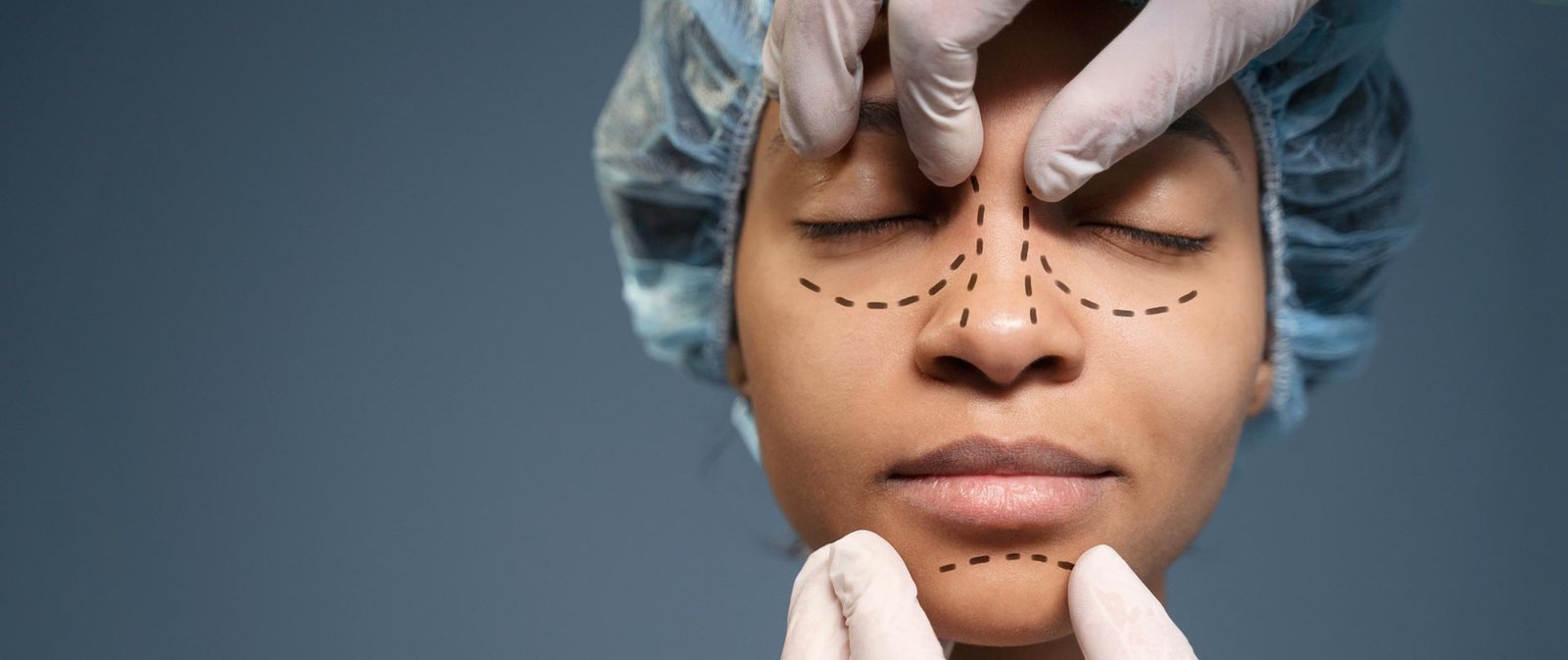 Rhinoplasty