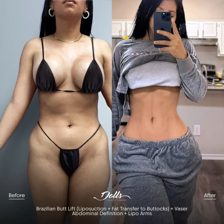 BBL--Ab--Def--Lipo--Cell--Saver-Berman