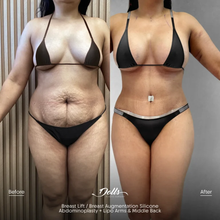BL-BAM-TT-Lipo-Arms-Zeichner-Post