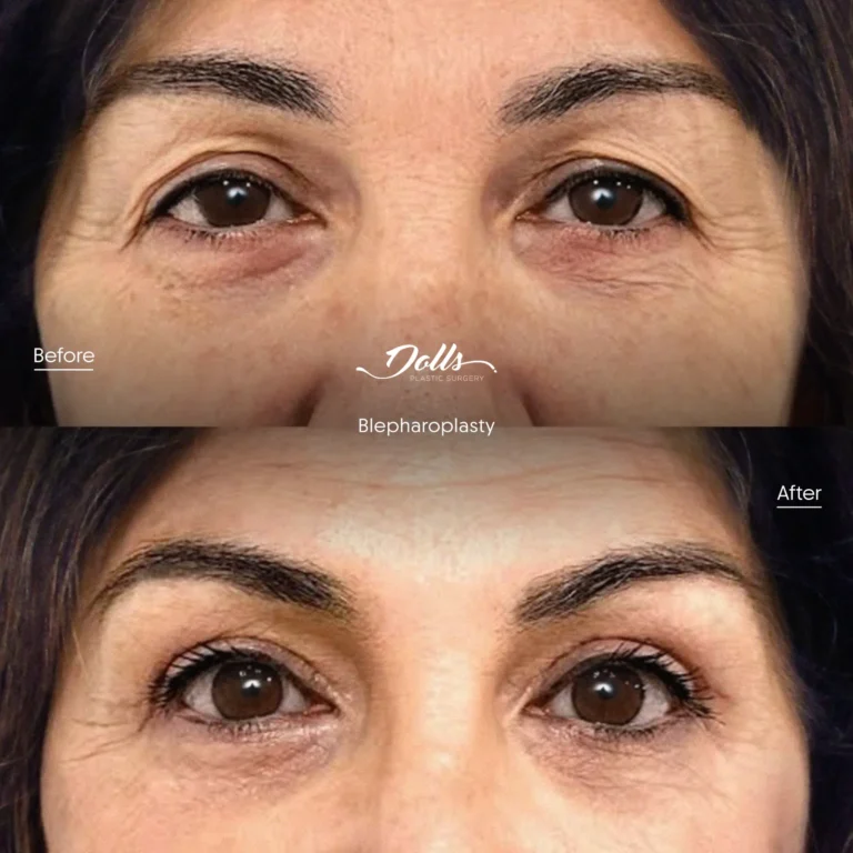 Blepharoplasty-1