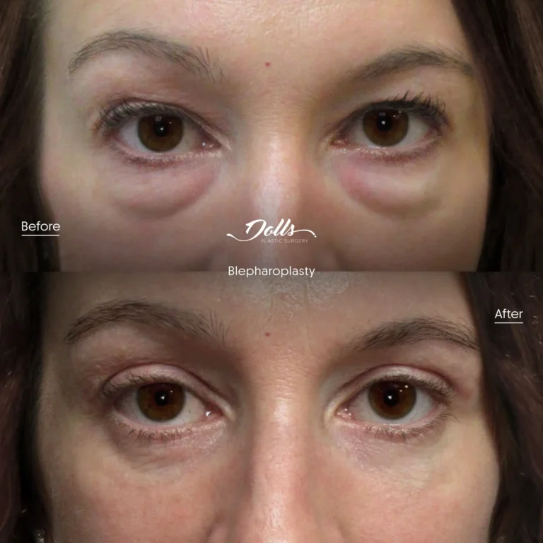 Blepharoplasty-10