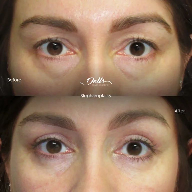 Blepharoplasty-14