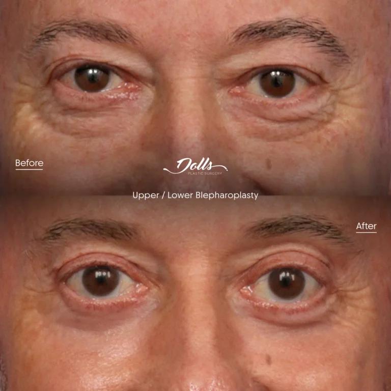 Blepharoplasty-7