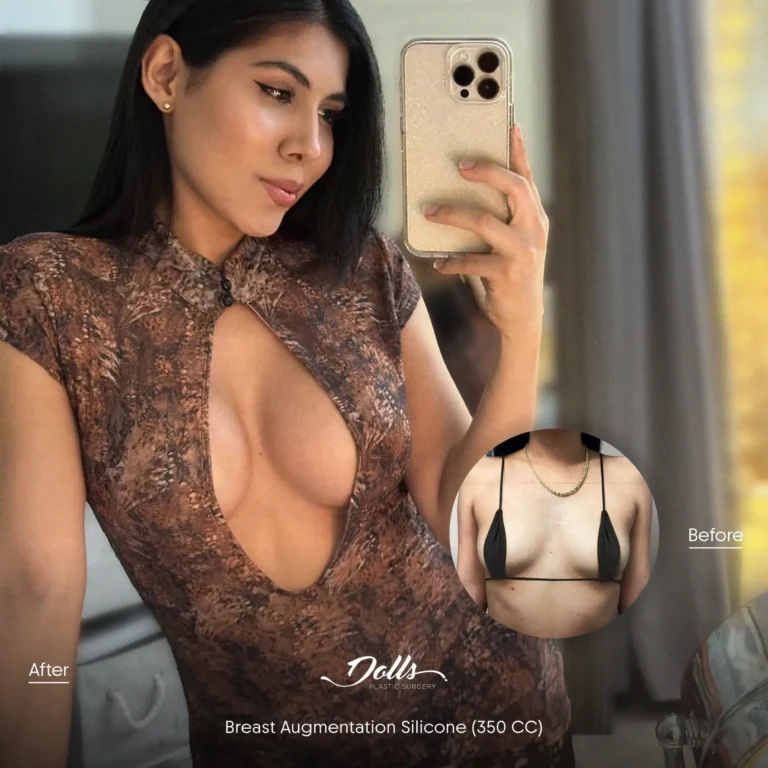 Breast-Augmentation-Silicone-Berman