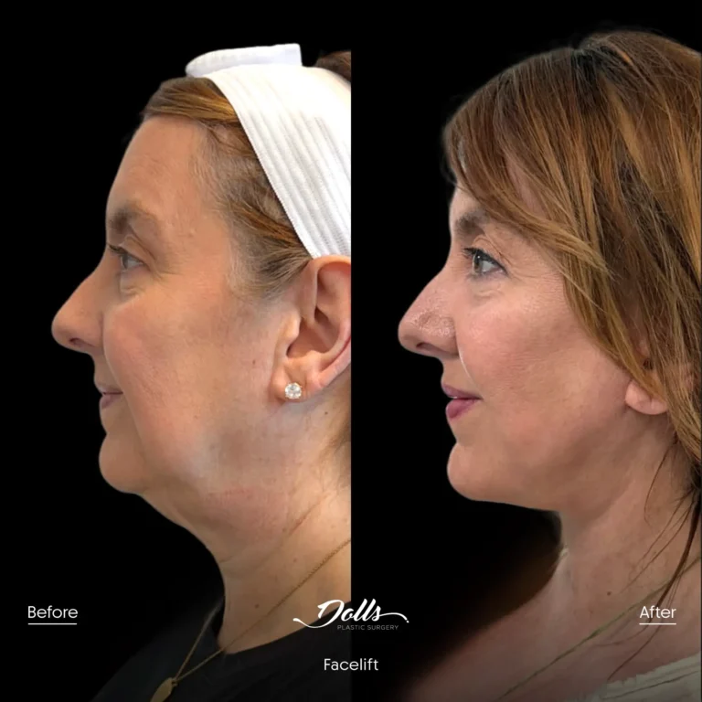 Facelift-Gorodisky 3