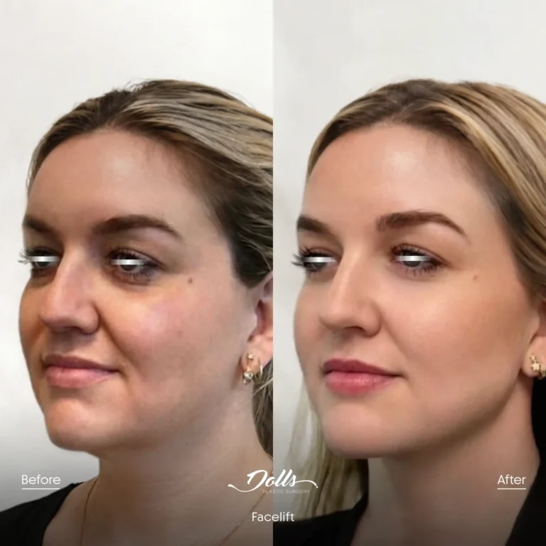 Facelift-Gorodisky