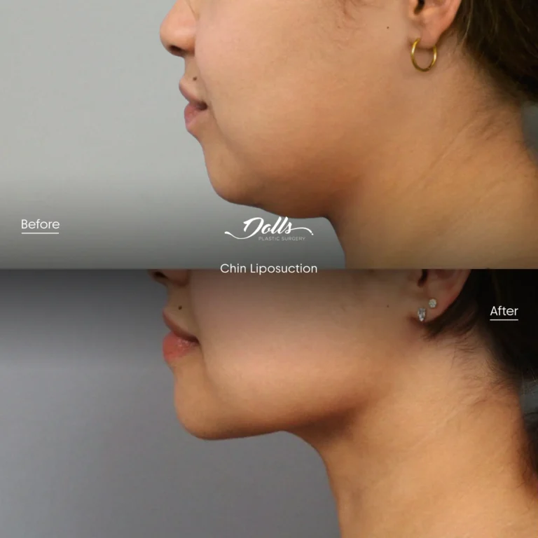 Lipo-Chin-10