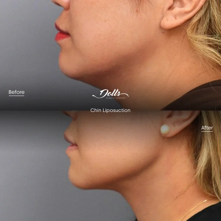 Lipo-Chin-13