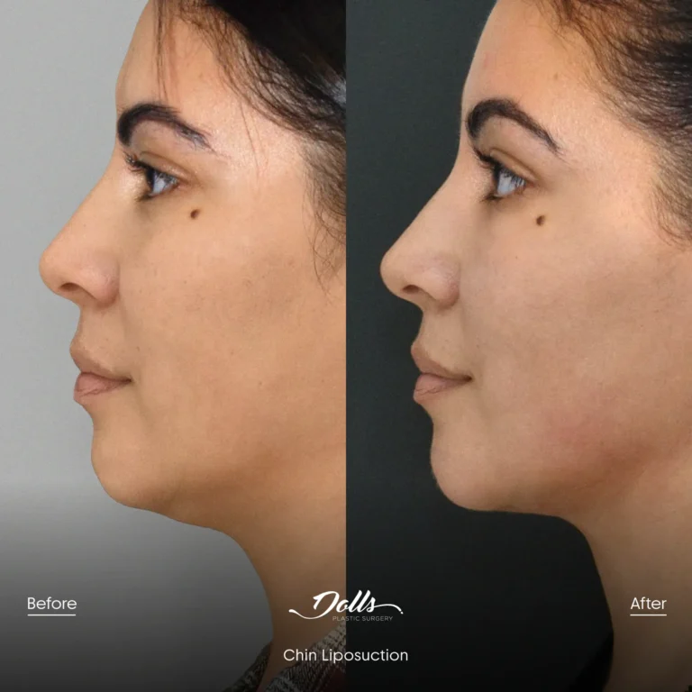 Lipo-Chin-16