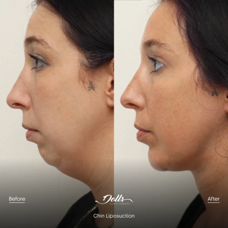 Lipo-Chin-5