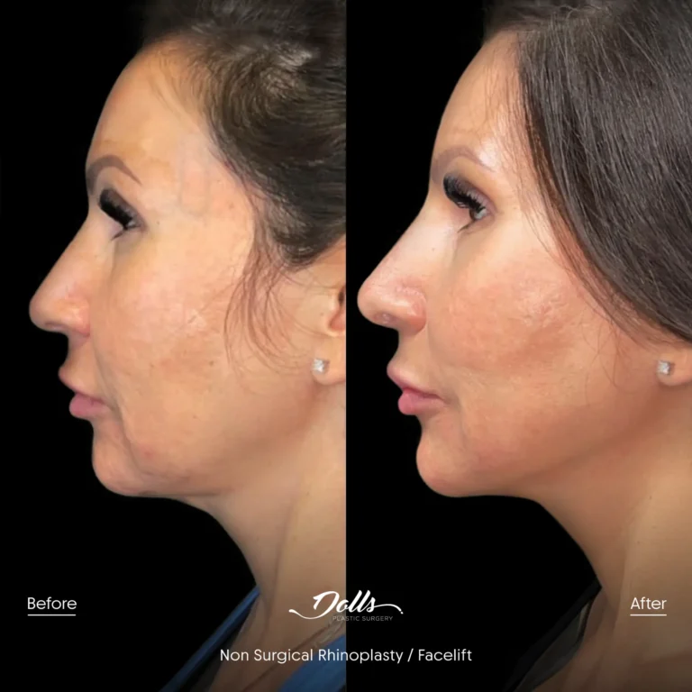 Non-Surgical-Facelift---Rhinoplasty-Gorodisky