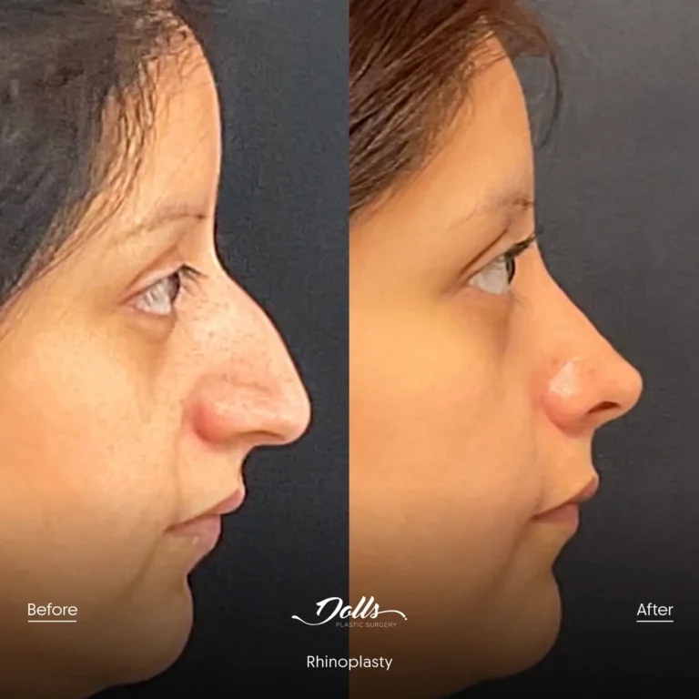 Rhinoplasty-Dr-Espinoza-Post-4