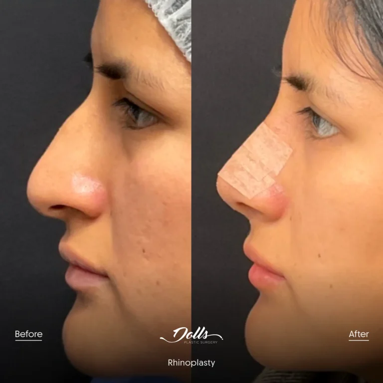 Rhinoplasty-Dr-Espinoza-Post-5