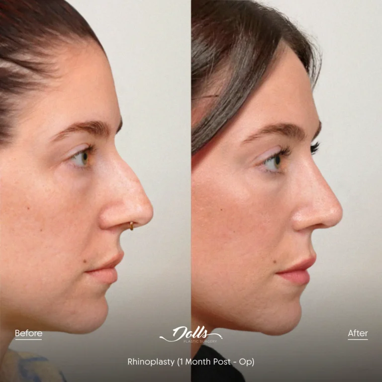 Rhinoplasty-Espinoza