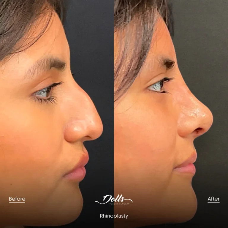 Rhinoplasty-Ronald-Espinoza-Post-1 2