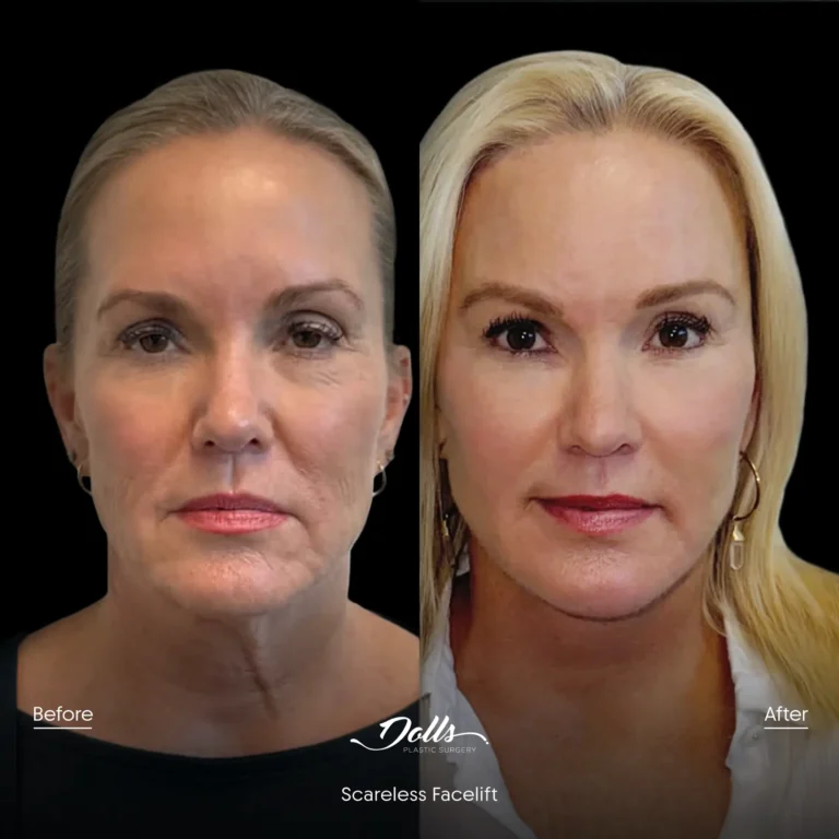 Scareless-Facelift-Gorodisky 2