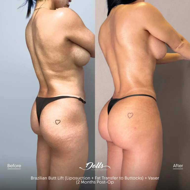 Vaser-Brazilian-Butt-Lift-Jonathan