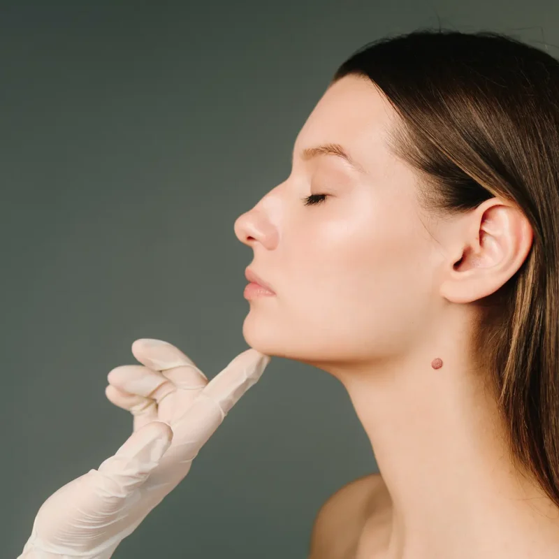 Chin Liposuction2