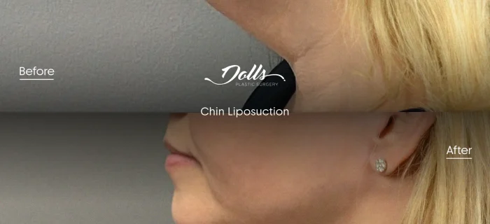 Lipo-Chin-15