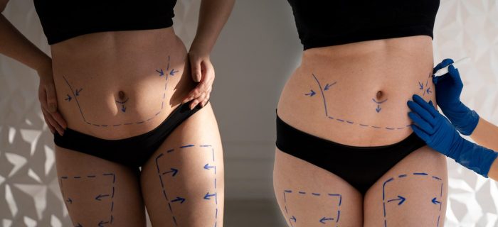 What is Liposuction