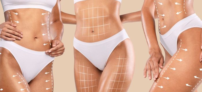 liposuction information