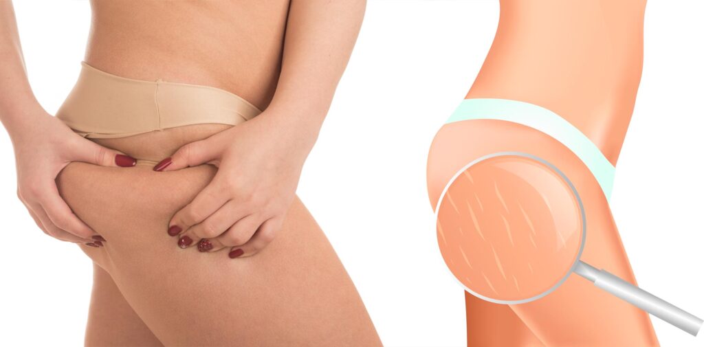 Aveli Cellulite Treatment