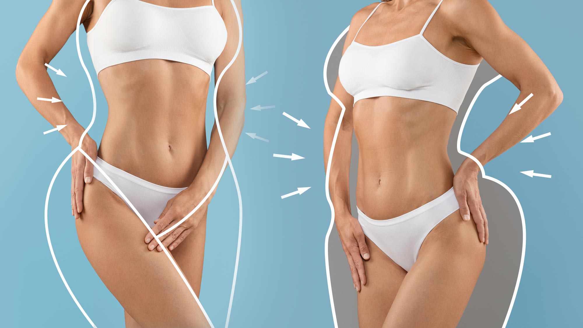 Best Lipo 360 in Miami Lipo 360 patients in Miami