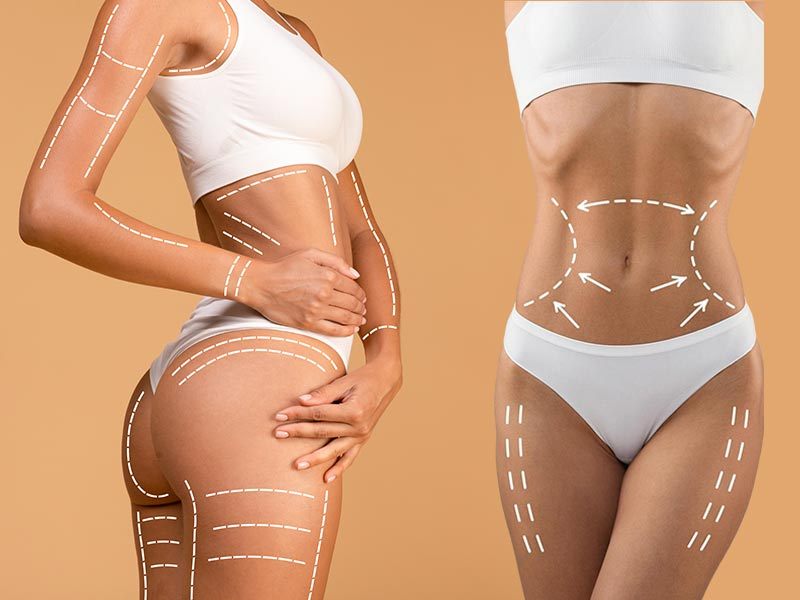 Best Lipo 360 in Miami liposuction 360 miami