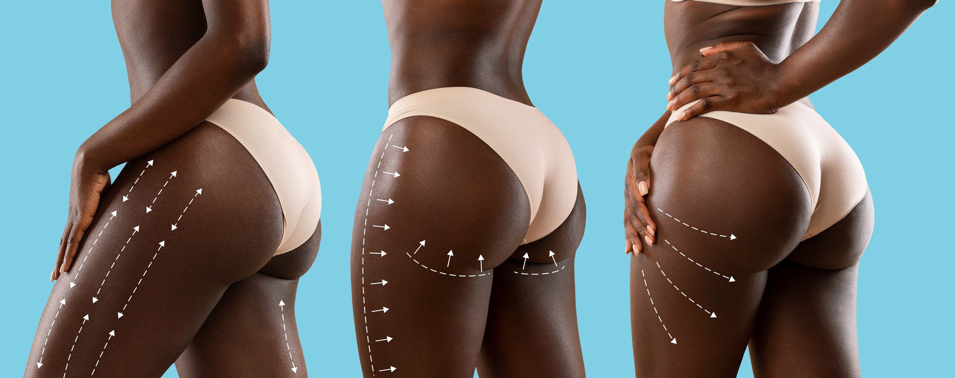 Brazilian Butt Lift