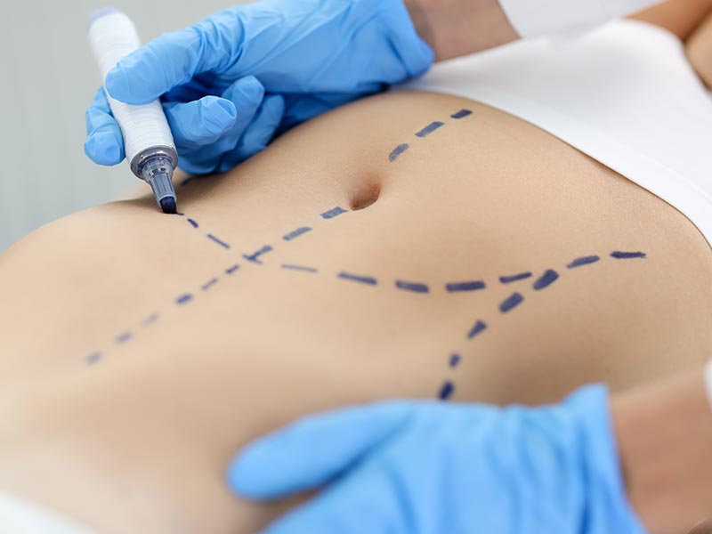 Tummy Tuck Miami FL - Natural Results with Top Surgeons at Dolls Plastic Surgery best tummy tuck surgeon in Miami FL
