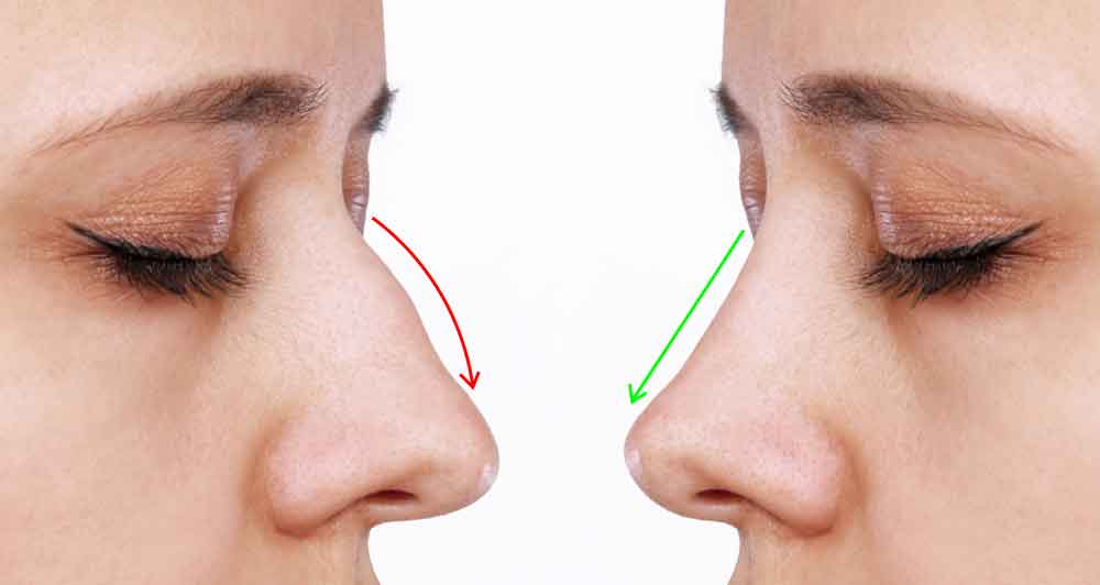 Ethnic Rhinoplasty Miami – Get a Celebrity Nose with Dr. Yuly Gorodisky rhino surgery