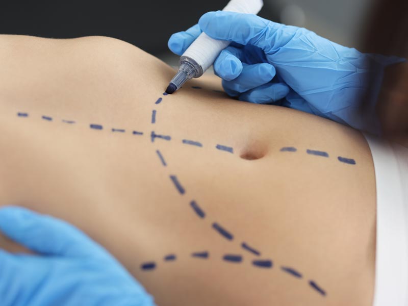 Tummy Tuck Miami FL - Natural Results with Top Surgeons at Dolls Plastic Surgery best tummy tuck surgeon in Miami FL